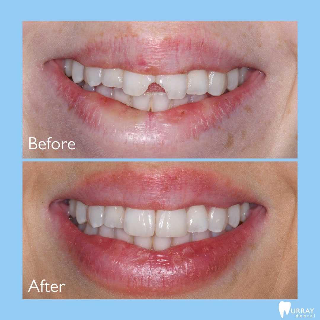 What Are The Differences Between Composite Resin Bonding & Veneers?