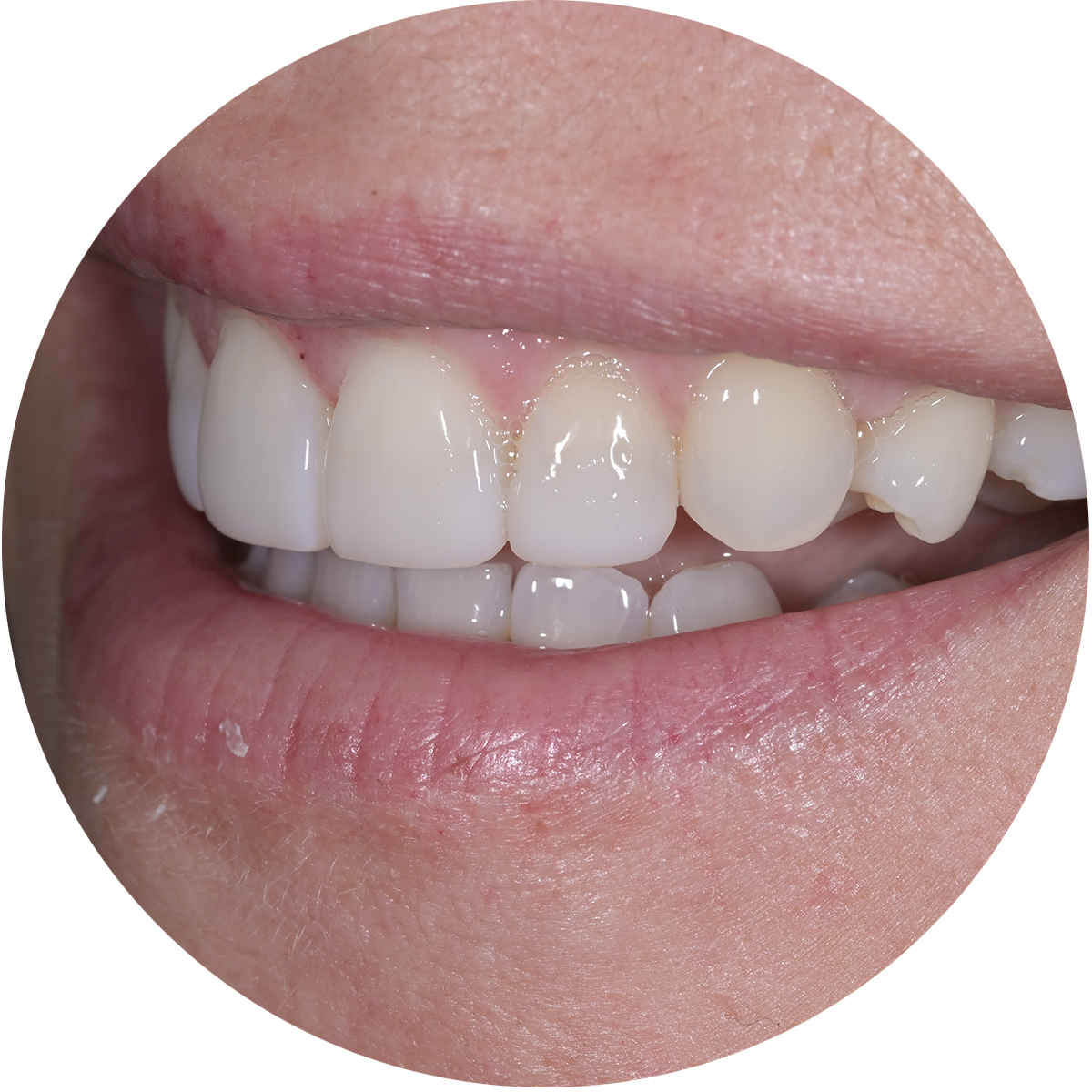 Murray Dental Banner Composite Bonding 02